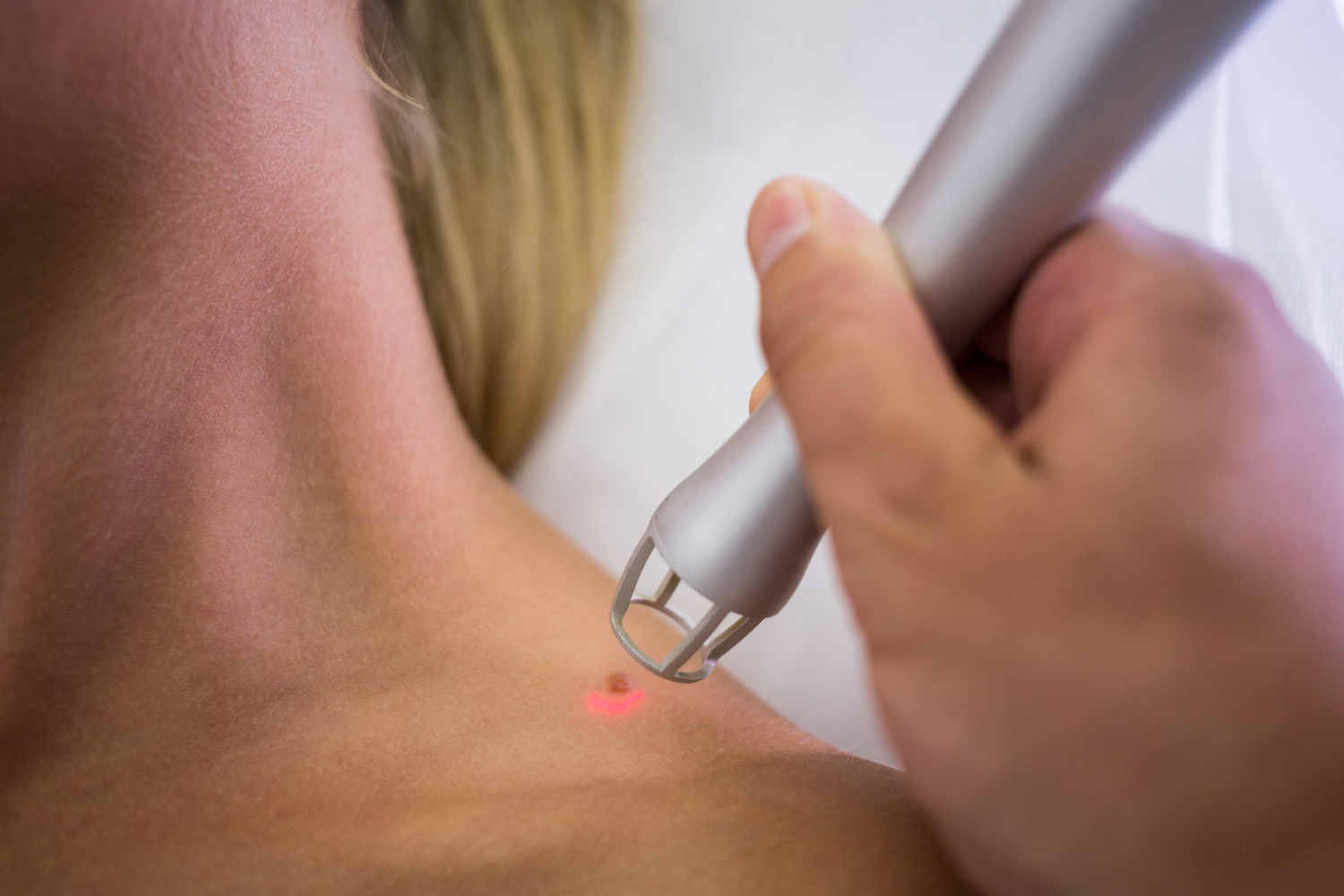 laser needle therapy